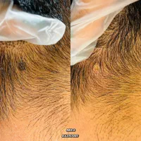 برداشتن انواع خال گوشتی،زگیل،منگوله،کک مک|خدمات آرایشگری و زیبایی|شیراز, شهرک امیر کبیر|دیوار