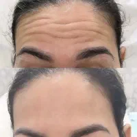 فیلر ،بوتاکس،مزوژل .زالو درمانی و حجامت بانوان