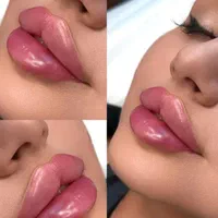 تزریق ژل،بوتاکس،فیلر ،مزوتراپی و پی آر پی