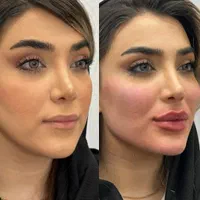 ژل بوتاکس فیلر چربی مزو جوانساز بلفارو درمطب پزشک|خدمات آرایشگری و زیبایی|کرج, گوهردشت|دیوار