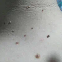 برداشتن خال و سوراخ کردن گوش