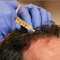 پی آر پی حجامت امبدینگ بادکش طب سوزنی فصد زگیل