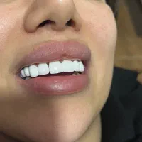 کامپوزیت و لمینیت vip