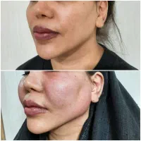 تزریق چربی برای مدت محدود|خدمات آرایشگری و زیبایی|تهران, ایرانشهر|دیوار