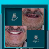 ایمپلنت دندان پزشکی تعرفه دولتی دندانپزشکی تضمینی|خدمات آرایشگری و زیبایی|شیراز, معالی‌آباد|دیوار