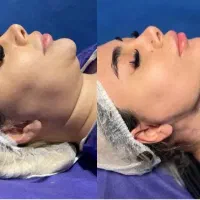 فیلر لب و سوپرکانتورینگ با ابداع کننده این تکنیک