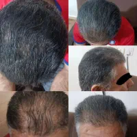 تنها متدی که تو خونه درمان میشی نانو درمانیه|آرایشی، بهداشتی، درمانی|کرمانشاه, |دیوار