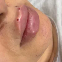 تزریق ژل لب روسی و ام تکنیک