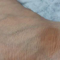 درمان تخصصی لک و فیشال کلینیک تخصصی کمیل|خدمات آرایشگری و زیبایی|اهواز, زیتون کارمندی|دیوار