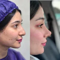 آف جراحی بینی فقط ۳۴ اهواز انجام میشه