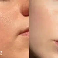 اتوی صورت-برای پاکسازی بیرون نرو خونه انجامش بده