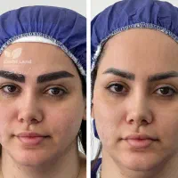 جشنواره کاشت ابرو مو غبغب بلفاروپلاستی سانترال لب