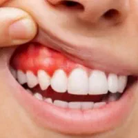 دندانسازی متحرک