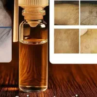 قطره برای رفع زگیل و منگوله گوشتی