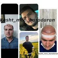 کاشت مو و ابرو در تبریز، پیش پرداخت ۶میلیون