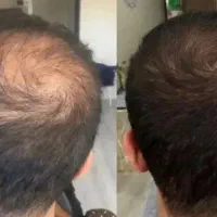 ریزش مو و رویش مجدد مو