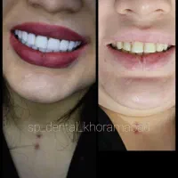 کامپوزیت اسپی دنتال