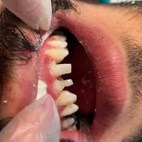 دندان مصنوعی و کامپوزیت|خدمات آرایشگری و زیبایی|سروآباد, |دیوار