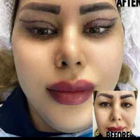 ساکشن و تزریق چربی جراحی و کاشت مووابردرمطب پزشک