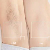 جشنواره لیزر حذف موهای زائد فول ۴۵۰|خدمات آرایشگری و زیبایی|ارومیه, |دیوار