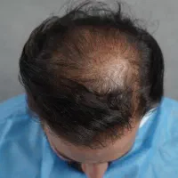 کاشت مو اردبیل /میکروگرافت / ۲۰ میلیون