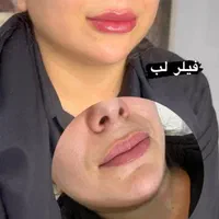 لیزر موهای زاید تزریق بوتاکس وژل  توسط پزشک|خدمات آرایشگری و زیبایی|تالش, هشتپر|دیوار