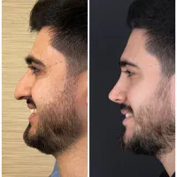 جراحی-زیبایی-بینی