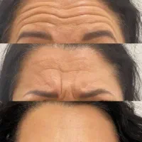 تزریق ژل وبوتاکس،پیرسینگ((نوروزی)