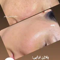 سالن تخصصی پوست ومو توسط منتخب مسابقات پوست کشور|خدمات آرایشگری و زیبایی|ساری, |دیوار