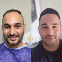 کاشت مو ۲۲ کاشت ابرو ۱۵