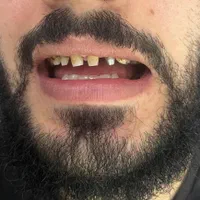 دندان مصنوعی|آرایشی، بهداشتی، درمانی|خوی, |دیوار