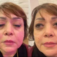 هایفو و جوانسازی صورت باتخفیف باور نکردنی|خدمات آرایشگری و زیبایی|قائمشهر, |دیوار