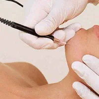 الکترولیز موهای زائد