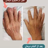 درمانگر بیماری روماتیسم و درد مفاصل