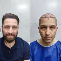 کاشت مو فقط 18میلیون تومان|خدمات آرایشگری و زیبایی|رشت, گلسار|دیوار