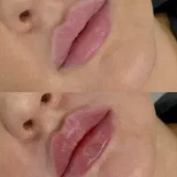 ژل لب،چونه ،آنزیم ،زاویه ،بوتاکس|خدمات آرایشگری و زیبایی|قم, تولید دارو و یخچال|دیوار