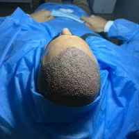 کاشت مو به روش Sp|خدمات آرایشگری و زیبایی|آذرشهر, |دیوار