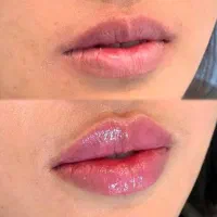 جشنواره ی پاییزه ژل ،بوتاکس،مزو|خدمات آرایشگری و زیبایی|شاهین‌شهر, فردوسی|دیوار