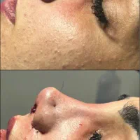 اف عمل زیبایی بینی|خدمات آرایشگری و زیبایی|دهدشت, |دیوار