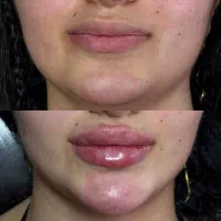 تخفیف ویژه تزریق ژل لب بوتاکس پرسینگ  برداشتن خال