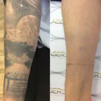 پاک کردن تتو.لیزرکیوسوییچ.PRP.کربن تراپی.روشن سازی|خدمات آرایشگری و زیبایی|اصفهان, سعادتآباد|دیوار