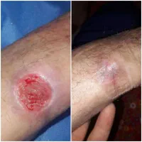 کارشناس تخصصی زخم و استوما|خدمات آرایشگری و زیبایی|قم, زنبیل آباد|دیوار