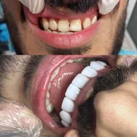 اف کامپوزیت سرامیکی و شیشه ای