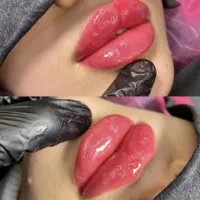 تزریق ژل،بوتاکس،فیلر،مزوتراپی،پی آر پی هایفو