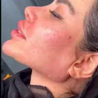 تزریق ژل لب .بوتاکس.لیفت نخ . درمان لک|خدمات آرایشگری و زیبایی|درگهان, |دیوار