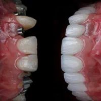 ایمپلنت و زیبایی دندانپزشکی