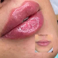 تزریق ژل  سی سی ۸۵۰