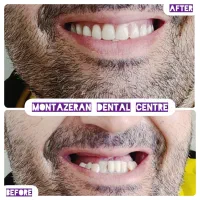 دندانسازی دندانساز دندان مصنوعی دندان باضمانت|آرایشی، بهداشتی، درمانی|مشهد, کوشش|دیوار