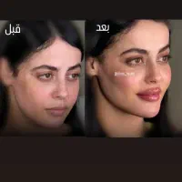 تخفیفات استثنایی ژل و بوتاکس در مطب زیبایی|خدمات آرایشگری و زیبایی|قم, دورشهر|دیوار