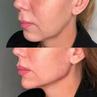 جشنواره ژل و بوتاکس با قیمت باورنکردنی/اقساط|خدمات آرایشگری و زیبایی|آمل, |دیوار